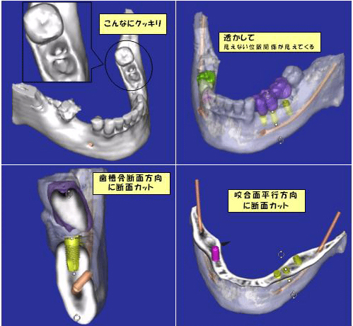 歯科用CT