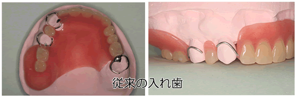 従来の入れ歯