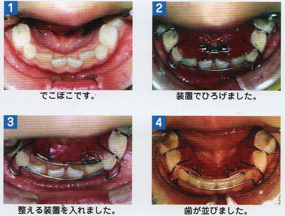 床矯正