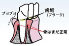 歯肉炎のイラスト