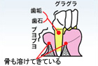 歯周病中期のイラスト