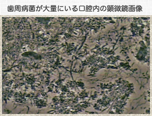 歯周病菌が大量にいる口腔内の顕微鏡画像