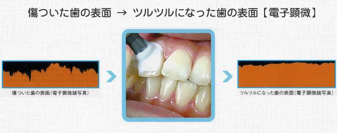 傷ついた歯の表面 → ツルツルになった歯の表面【電子顕微】