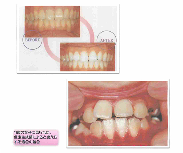 エナメル質表面の着色