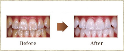 ホワイトニングの効果は個人差があります。